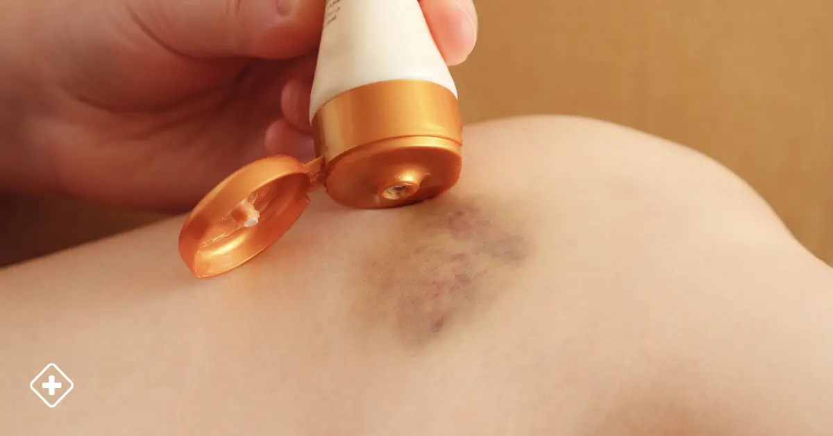 Hematomas (Moretones)